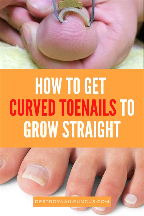 Curved Toenails Treatment - Bios Pics