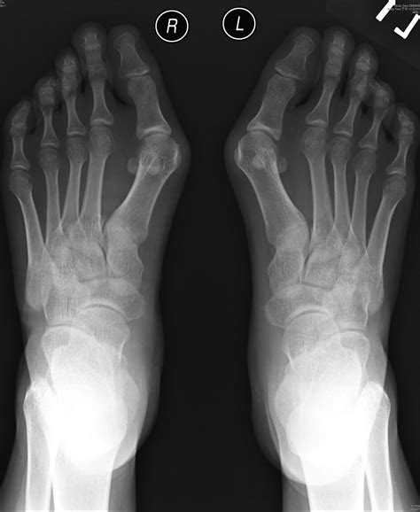 Big Bad: Hallux valgus