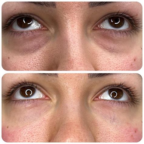 tear trough dermapharm aesthetics