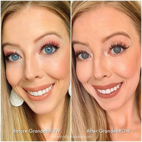 Unbelievable Blackhead Removal 2024: My Honest Review & Before/After Pics. Image 14