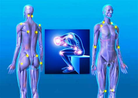 Fibromyalgia Treated with Acupuncture - Abacus Chinese Medicine