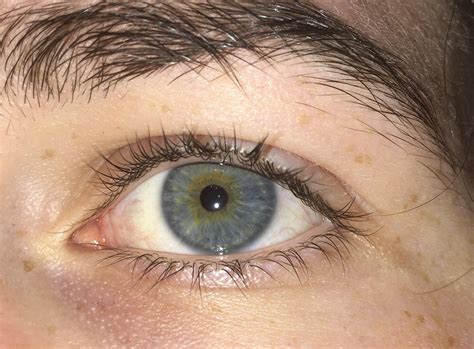 Central Heterochromia? : eyes