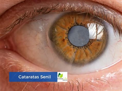 O Que É Catarata Senil - Cataratas Senil: Todo lo que Necesitas Saber