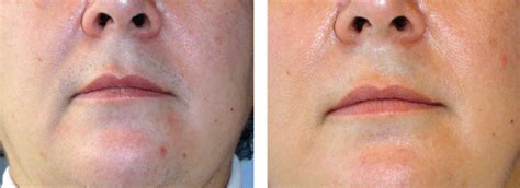 Laser Nose Hair Removal - VIVA Concept Technology