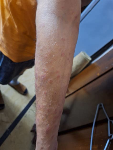 Ask a Dermatologist Online for Skin Rashes