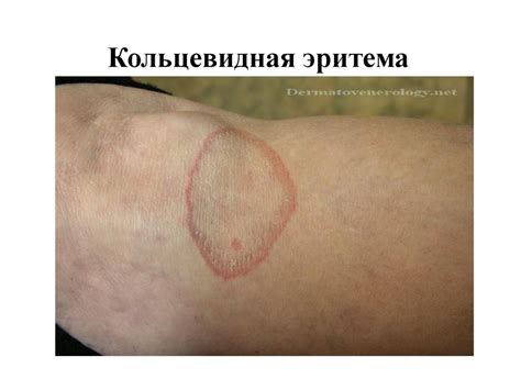 Острая ревматическая лихорадка. Миокардиты - презентация онлайн