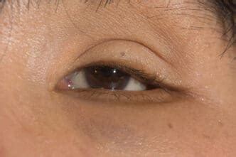 sunken eyes   treatment myvisionorg