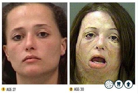 Krokodil Drug Effects On Skin