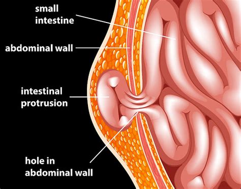 Abdominal Wall Hernia | Ocean Surgical