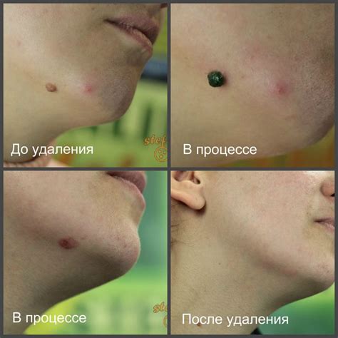 Родинка, которую я решилась удалить находилась у меня на подбородке ...