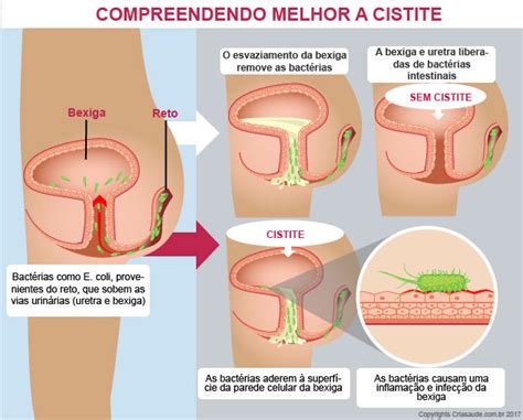 O Que Causa A Cistite - Cistite: causas, sintomas & tratamentos | Criasaude