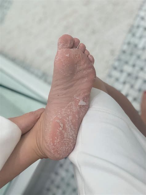 foot peel mask review before and after - See (Anna) Jane.