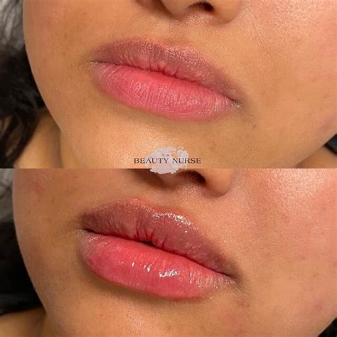 Should Lips Bruise After Filler | Lipstutorial.org