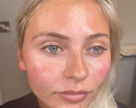 tear trough dr claire aesthetics