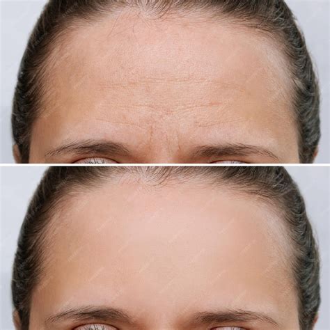 Botox Testa Antes E Depois - Jovem com rugas na testa antes e depois do lifting facial, procedimento ...