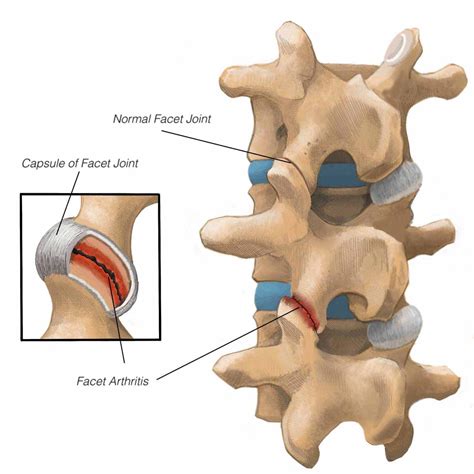 Cervical Facet Joint Pain | Complete Physio