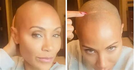 Quem Tem Alopecia Pode Pintar O Cabelo - Tipos de alopecia, uma condição que leva à queda de cabelo