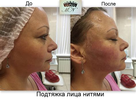 Нити для подтяжки лица - какие выбрать, рассказывает косметолог