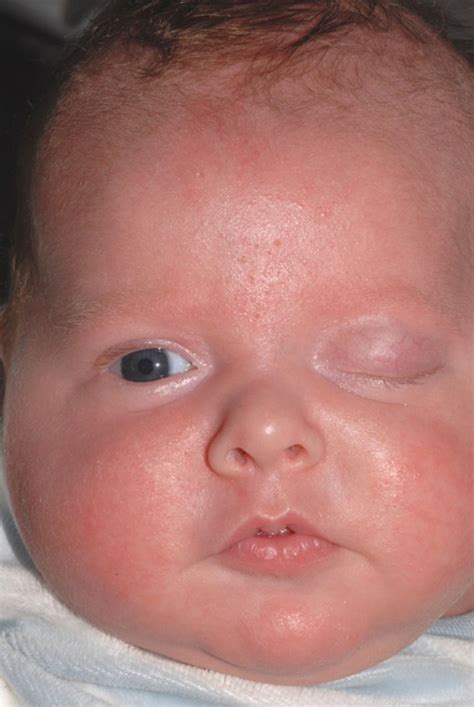 An interesting case of ptosis in an infant | ADC Education & Practice ...