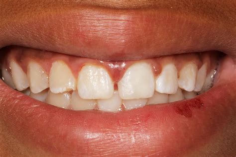 broken front tooth dental emergency nyc dentist