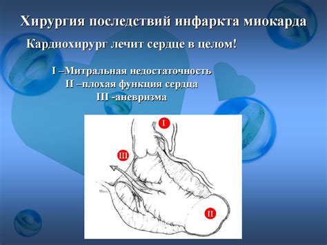 Инфаркт миокарда - online presentation
