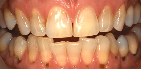 What is Dental erosion?