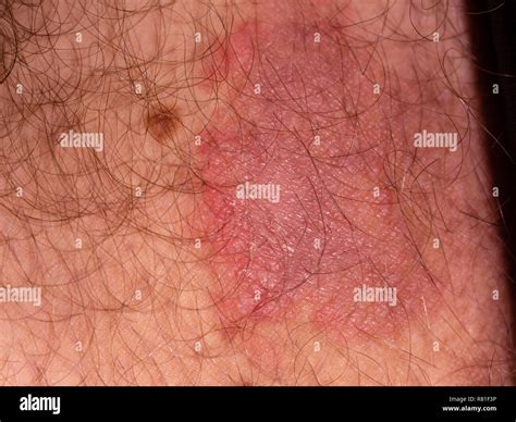 fungal infection  groin area  madison hales blog