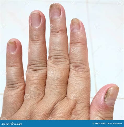 The Left Fingernail with Nail Disease Stock Photo - Image of fingernail