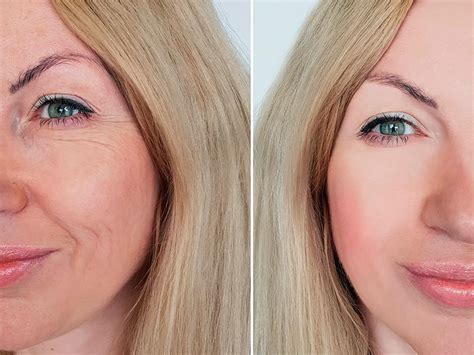 Preenchimento Com Ácido Hialurônico Antes E Depois 50 Anos
