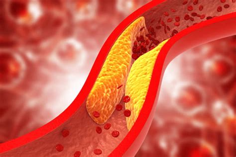 arterial blockage modern heart  vascular
