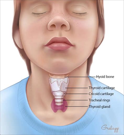 laryngeal  tracheal stenosis stanford medicine childrens health