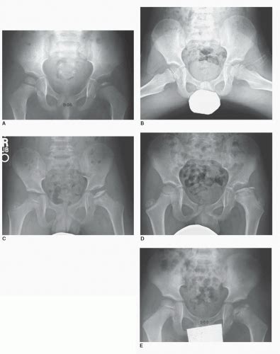 Perthes Disease | Musculoskeletal Key