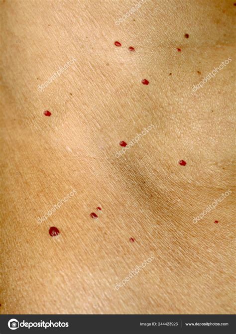 Angioma na kůži. Červené znamének na těle. Mnoho mateřská znaménka ...