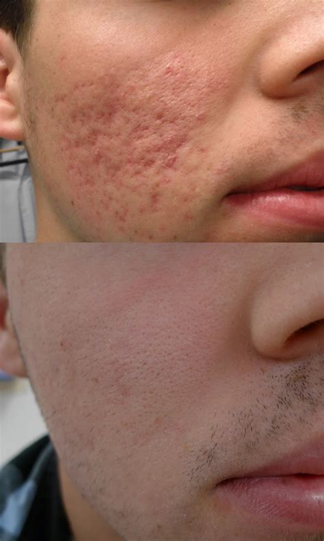 Moderate Acne Scars Treatment