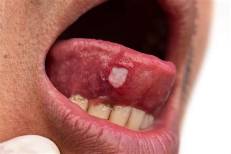 240+ Tongue Ulcer Stock Photos, Pictures & Royalty-Free Images - iStock