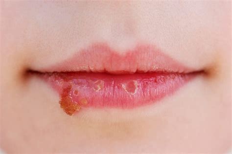 Oq E Herpes Na Boca - Herpes na boca: O que é, causas, sintomas e tratamentos
