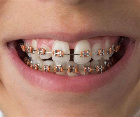 Braces in New Braunfels l Premier Dental Center New Braunfels