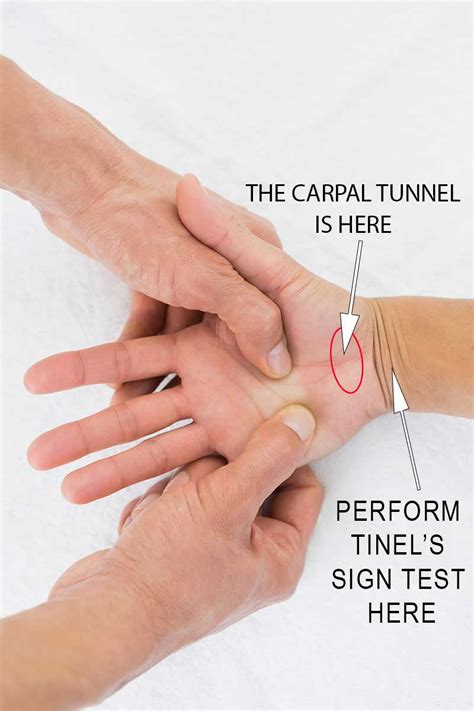 how to know if u have carpal tunnel