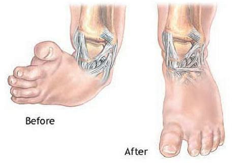 Club foot Treatment in Kenya | Pediatric Orthopedic Surgeon in Nairobi