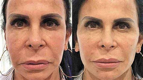 Armonizacao Facil Antes E Depois - Harmonização facial antes e depois: saiba se vale a pena!