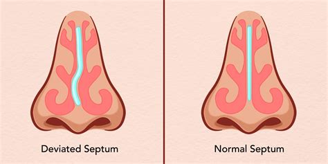 deviated septum anderson sobel cosmetic surgery