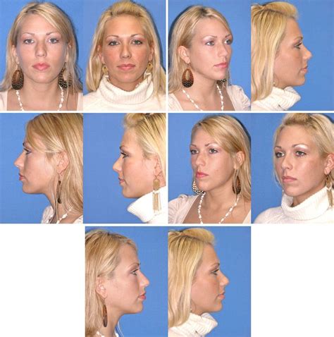 rhinoplasty nose surgery photo gallery rhinoplasty nose surgery