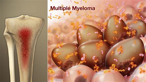 multiple myeloma