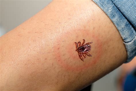 Lyme Disease: Causes, Symptoms, Treatment and Prevention | updated 2024