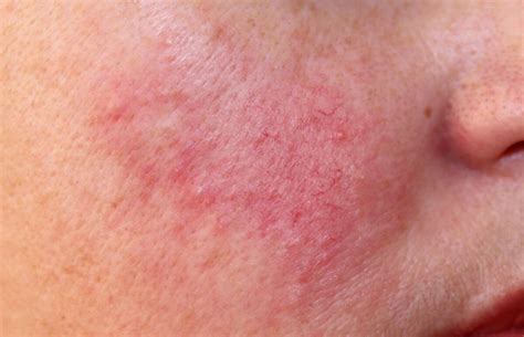face rosacea skin redness treatments london premier laser