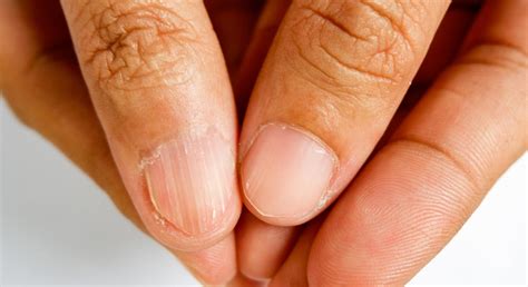 Iron Deficiency Anemia Nails