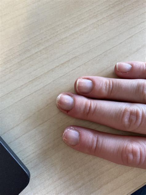 How to make nails look better while rehabbing them? They were breaking ...