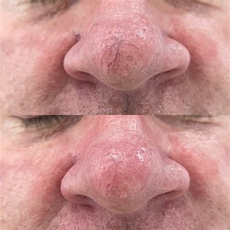 Broken Capillaries on Face | IPL for Broken Capillaries on Face | IPL Nose