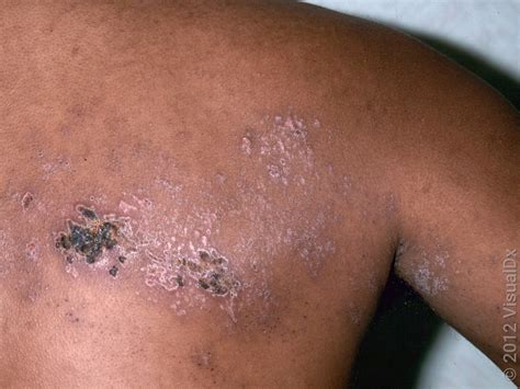 What to Expect With Shingles Rash: Early Stages and Progression - GoodRx