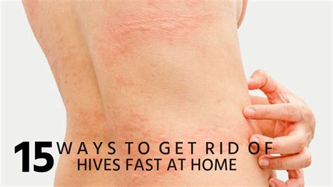 pin  urticaria